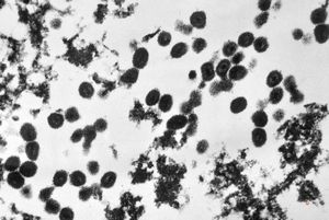 F,8y. | varicella pneumonia F,8y. | varicella pneumonia